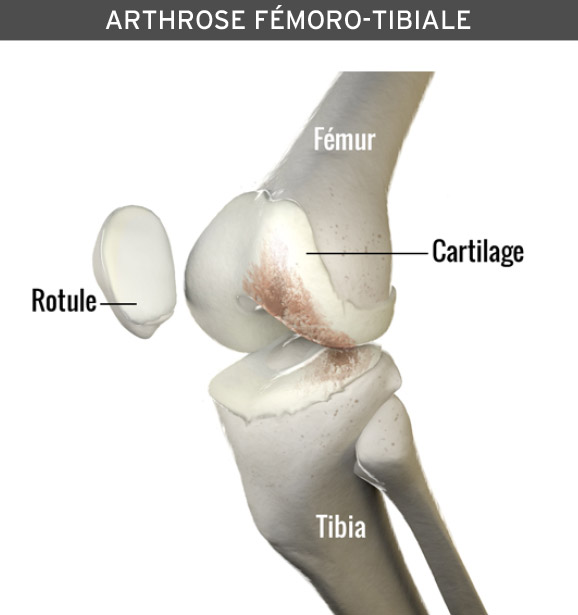 Velo appartement et arthrose du genou